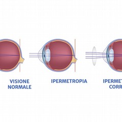 L’antagonista della miopia: l’ipermetropia