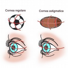 Cos’è l’astigmatismo?