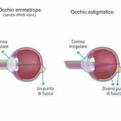 Cos’è l’astigmatismo?