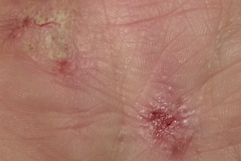 dermatite atopica