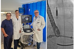 Cardiologia del Bonomo, per la prima volta in Puglia il dispositivo "Impella"
