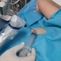 Nuova tecnica radiologica al "Bonomo " di Andria con la crioablazione