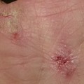Giornata sulla dermatite atopica: screening gratuiti presso la Asl Bt